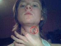 Повышенная функция щитовидной железы
