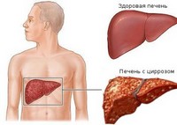Болезнь цирроз печени
