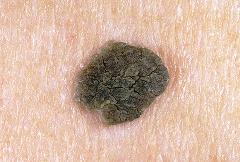 keratoma