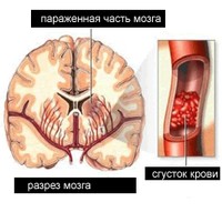 Склероз сосудов головного мозга лечение