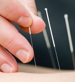 Иглоукалывание избавит от рвотного рефлекса в стоматологическом кресле