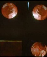 Ученые разработали таблетки, которые помогут выявить рак желудка 