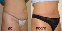 Подтяжка кожи живота