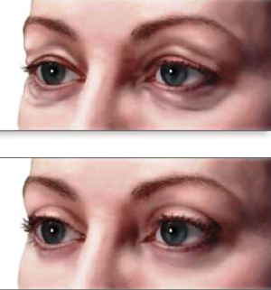 blefaroplastika