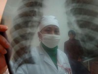 Туберкулез симптомы признаки