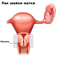 Лечение рака матки в Израиле